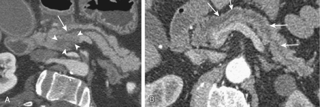 Figure 51-4, Chronic obstructive pancreatitis. Curved reformatted images in two different patients. A, A hypodense mass (carcinoma) (arrowheads) is seen in the head and uncinate process of the pancreas with abrupt cutoff of the pancreatic duct (arrow) and upstream dilatation. The pancreatic parenchyma reveals mild atrophy. B, Diffuse dilatation of the pancreatic duct (arrows) with mild parenchymal atrophy without any evident mass lesion in this case of main duct intraductal papillary mucinous neoplasm.