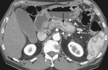 Figure 51-5, Autoimmune pancreatitis. Axial computed tomography image reveals a swollen pancreas with a peripancreatic hypodensity (halo) (arrowheads), minimal peripancreatic stranding (asterisk), irregularity of the pancreatic duct (vertical black arrow), and retraction of the pancreatic tail (white arrow).
