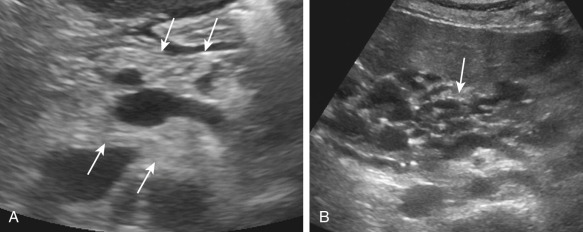 Figure 51-6, Cystic fibrosis. Ultrasound images reveal hyperechoic pancreatic parenchyma ( arrows, A ) and diffuse cystosis of the pancreas with interspersed echogenic pancreatic parenchyma ( arrow, B ).