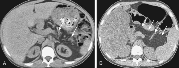 Figure 51-7, Cystic fibrosis. Axial computed tomography images demonstrate fatty changes in the pancreas with interspersed residual pancreatic parenchyma ( arrows, A ) and complete replacement of pancreas by fat ( arrows, B ).