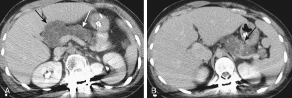 Figure 51-9, Cystic fibrosis. Axial computed tomography images reveal diffuse pancreatic cystosis involving the head, neck, body ( black and white arrows, A ) and tail of the pancreas ( black arrow, B ).