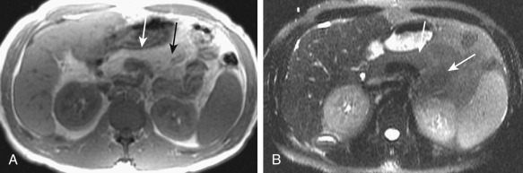 Figure 51-10, Cystic fibrosis. Axial T1-weighted (A) and T2-weighted fat-suppressed (B) magnetic resonance images reveal near-complete fatty replacement of pancreas (arrows), appearing isointense to the retroperitoneal fat.