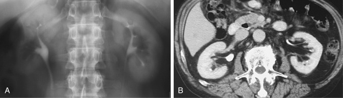 Figure 64-1, Renal sinus lipomatosis in a case with mild bilateral renal parenchymal disease. A, Intravenous pyelogram shows low-density prominent renal sinus fat. B, Computed tomography scan in the same patient confirms sinus lipomatosis.