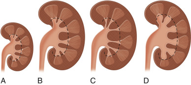 Figure 64-11, Diagrammatic representation of a spectrum of renal abnormalities in diseases causing generalized increase in renal bulk. A, Normal kidney. B, Enlarged kidney with normal pelvicalyceal system. C, Renal enlargement with constriction of pelvicalyceal system. D, Renal enlargement secondary to obstructive nephropathy.