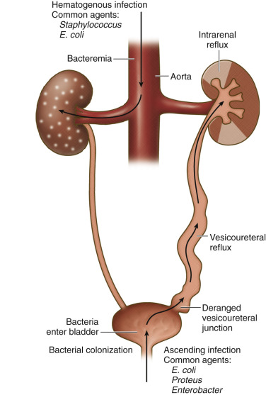 Figure 64-13, Pathoanatomy of pyelonephritis. Ascending infection via the ureter is the most important cause and results from vesicoureteral reflux from the lower urinary tract. Hematogenous infection is less common and results from septicemia or bacterial endocarditis.