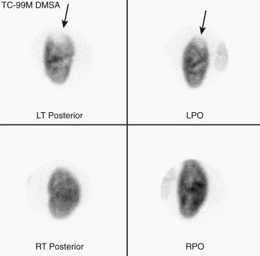 Figure 64-16, Technetium-99m ( 99m Tc)-dimercaptosuccinic acid (DMSA) scan showing a focal photopenic defect (arrows) in the upper pole of the left kidney (top row) that was confirmed to be an area of focal acute pyelonephritis on computed tomography scan. Notice the normal parenchymal tracer uptake in the right kidney (bottom row).