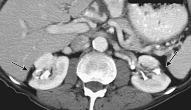 Figure 64-17, Contrast-enhanced computed tomography study showing bilateral renal cortical scarring (arrows) consistent with chronic pyelonephritis.