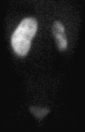 Figure 64-18, Technetium-99m ( 99m Tc)-labeled mercaptoacetyl triglycine ( 99m Tc-MAG3) scan showing small poorly functioning right kidney with split renal function of 12%.