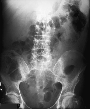 Figure 64-20, Kidney, ureter, and bladder radiograph showing mottled air bubbles in the expected location of the left ureter consistent with emphysematous pyelitis. Note also the presence of ill-defined air bubbles in the left renal parenchyma also consistent with emphysematous pyelonephritis.