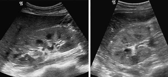 Figure 64-2, Longitudinal and transverse ultrasound images of the right kidney show an enlarged echogenic kidney with mild prominence of the relatively hypoechoic medullary pyramids. This is a nonspecific finding seen in patients with diffuse renal parenchymal disease.