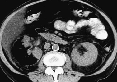 Figure 64-21, Axial computed tomography images through the kidneys in a patient with diabetes, demonstrating the presence of air within the renal parenchyma consistent with emphysematous pyelonephritis.