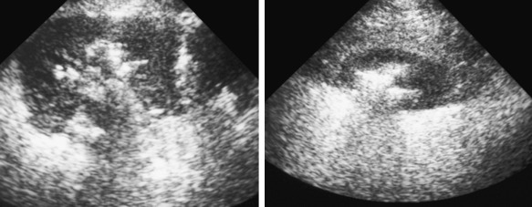 Figure 64-22, Ultrasound images through the kidney showing the presence of echogenic material with “dirty” shadowing consistent with parenchymal air secondary to emphysematous pyelonephritis.