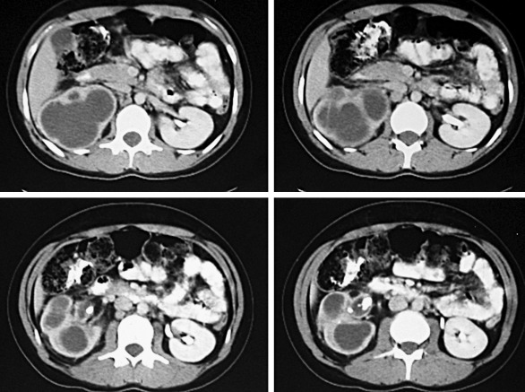 Figure 64-23, Contrast-enhanced computed tomography scan through the abdomen demonstrates multiple calculi in the renal pelvis and replacement of the normal right renal parenchyma with multiple cystic areas. These findings are consistent with xanthogranulomatous pyelonephritis.