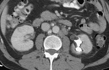 Figure 64-3, Delayed image from contrast-enhanced computed tomography shows a unilateral small scarred kidney in a case of chronic pyelonephritis. Note the polar scar and the corresponding clubbed calyx in the left kidney.