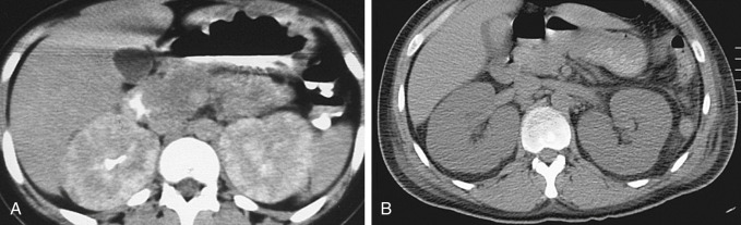 Figure 64-4, Bilateral enlarged kidneys. Two different cases. A, A patient presented with a known history of lymphoma. Delayed image from contrast-enhanced computed tomography (CT) through the kidneys shows bilateral enlarged kidneys. The extremely heterogeneous appearance is consistent with diffuse parenchymal infiltration by lymphoma. B, Noncontrast CT in a patient with human immunodeficiency virus infection shows diffusely enlarged kidneys, a nonspecific finding seen in renal parenchymal diseases.