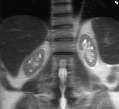 Figure 64-5, Coronal T2-weighted single-shot magnetic resonance image shows bilateral, small, smooth kidneys in a patient with end-stage renal disease secondary to multiple myeloma.