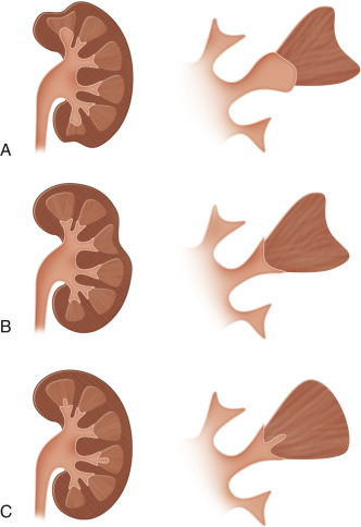 Figure 64-8, Focal loss of renal tissue. Diagrammatic representation of the pyelocalyceal and corresponding renal contour abnormalities. A, Reflux nephropathy, which shows papillary abnormality with overlying scar commonly seen at the renal poles. B, Lobar infarction showing scar with no underlying papillary abnormality. C, Papillary necrosis showing random papillary abnormalities without cortical involvement.