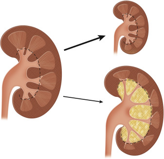 Figure 64-9, Renal response to diseases causing global loss of renal bulk. The kidney usually responds by showing a decrease in renal size (thick arrow). Also note that the renal contour is smooth and the normal pelvicalyceal relationships are preserved. Uncommonly, there may be replacement of the wasted renal tissue with fatty proliferation in the renal sinus (renal sinus lipomatosis). The reduction in renal length is less in this case (thin arrow).