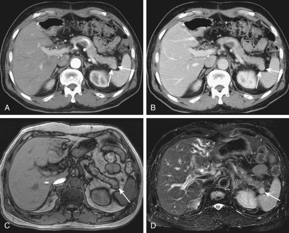 Figure 60-1, Accessory spleen. Axial contrast-enhanced computed tomography scans during the arterial phase (A) and the portal venous phase (B) show an accessory spleen (arrows) adjacent to the pancreatic tail, seen as a well-defined nodule with the same enhancement pattern as the parent spleen. On magnetic resonance imaging, an accessory spleen (arrow) has a signal intensity similar to that of normal spleen on T1-weighted (C) and T2-weighted (D) images.