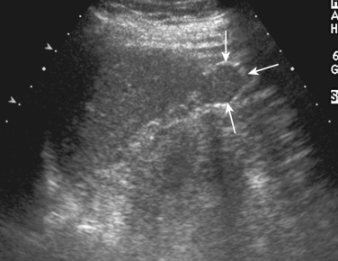 Figure 60-2, Accessory spleen. Oblique coronal ultrasound image of the left upper quadrant shows an accessory spleen (arrows), inferior to the main splenic body, producing the same echogenicity as the main spleen.