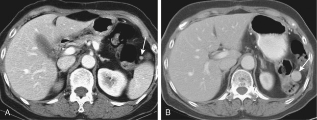 Figure 60-3, Hypertrophy of accessory spleen. A, Axial contrast-enhanced computed tomography (CT) shows a small accessory spleen (arrow) anterior to the main splenic body. B, The patient underwent distal pancreatectomy and splenectomy for the treatment of cystic pancreatic tumor (mucinous cystadenoma, not shown). On follow-up CT 3 years after the splenectomy, the remnant accessory spleen is hypertrophied to approximately 2 cm. Typical location, smooth margin, homogeneity, and good enhancement are the diagnostic clues of accessory spleen, and it should not be misdiagnosed as lymph node metastasis or a peritoneal seeding nodule in patients with malignancy and desmoid tumor.