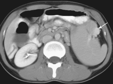 Figure 60-4, Wandering spleen. Axial contrast-enhanced computed tomography shows incorrect location of the spleen in the left midabdomen, which is the most common location of the wandering spleen. Typical comma-shaped appearance of the spleen is noted as well as normal splenic vessels (arrow) in the laterally fronted splenic hilum.