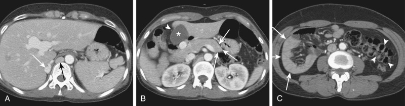 Figure 60-5, Polysplenia syndrome. A, Axial contrast-enhanced computed tomography (CT) image shows multiple spleens in the left upper quadrant. There is an aberrant collateral vessel (white arrow) posterior to the hepatic bare area and engorgement of the azygos vein (black arrow), resulting from an interruption of the inferior vena cava. Also noted is the portal vein variation with total ramification of the intrahepatic portal branches from the right-sided umbilical segment. B, CT image shows a truncated pancreas, with only the presence of the pancreatic head and small body and with abrupt termination without a tail (arrows). Also noted is a slightly left-sided gallbladder (asterisk) compared with the fissure for the ligamentum teres (arrowhead). C, Intestinal malrotation is also appreciated, with right-sided small bowel (arrows) and left-sided colon (arrowheads).