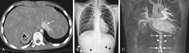 Figure 60-6, Asplenia syndrome. A, Axial contrast-enhanced computed tomography scan shows the absence of the spleen, a right-sided stomach (asterisk), and midline location of the large liver. A Levin tube (small arrow) is inserted in the stomach. Also noted is the abnormal location of the inferior vena cava (large arrow) in left juxtaposition to the aorta. B, Chest radiograph shows bilaterally symmetric bronchial trees with right isomerism. The main bronchus (long arrow) of the left lung is as short as the right main bronchus (short arrow). The shadow of the liver (arrowheads) is noted in both right upper and left upper quadrants of the abdomen. C, Magnetic resonance angiography depicts a left ipsilateral position of the aorta (arrows) and the inferior vena cava (arrowheads). The patient underwent a Fontan operation for complex congenital heart disease, including pulmonary stenosis.