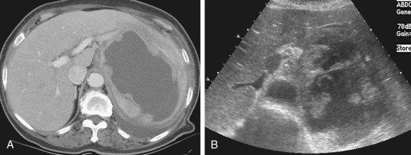 Figure 60-7, Pyogenic splenic abscess. A, Axial contrast-enhanced computed tomography scan shows a large masslike lesion in the spleen, with a center of low attenuation surrounded by a thick, irregular rim. B, Transverse abdominal sonogram depicts a large, poorly defined mass with dirty internal echo and irregular rim. Pyogenic splenic abscess was diagnosed by microscopic examination of the specimen obtained by percutaneous aspiration, and Enterococcus faecium was isolated.