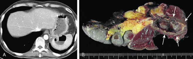 Figure 60-8, Pyogenic splenic abscess. A, Axial contrast-enhanced computed tomography scan shows a pyogenic splenic abscess, with an air/fluid level. B, The patient underwent splenectomy. The gross specimen shows a splenic abscess (arrows) with a thick, irregular wall.