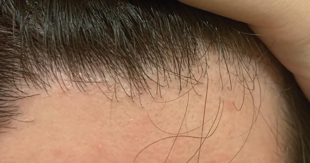 Fig. 13.1, Early Androgenetic Alopecia in a 26-Year-Old Male.