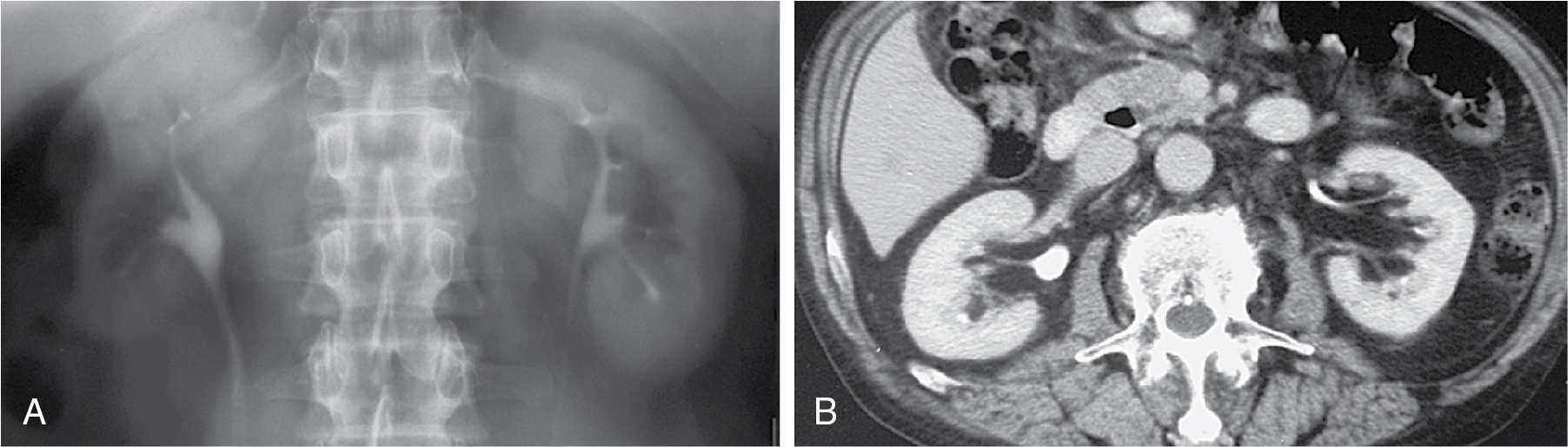 Fig. 25.1, Renal sinus lipomatosis in a case with mild bilateral renal parenchymal disease. A, Intravenous pyelogram shows low-density prominent renal sinus fat. B, Computed tomography scan in the same patient confirms sinus lipomatosis.