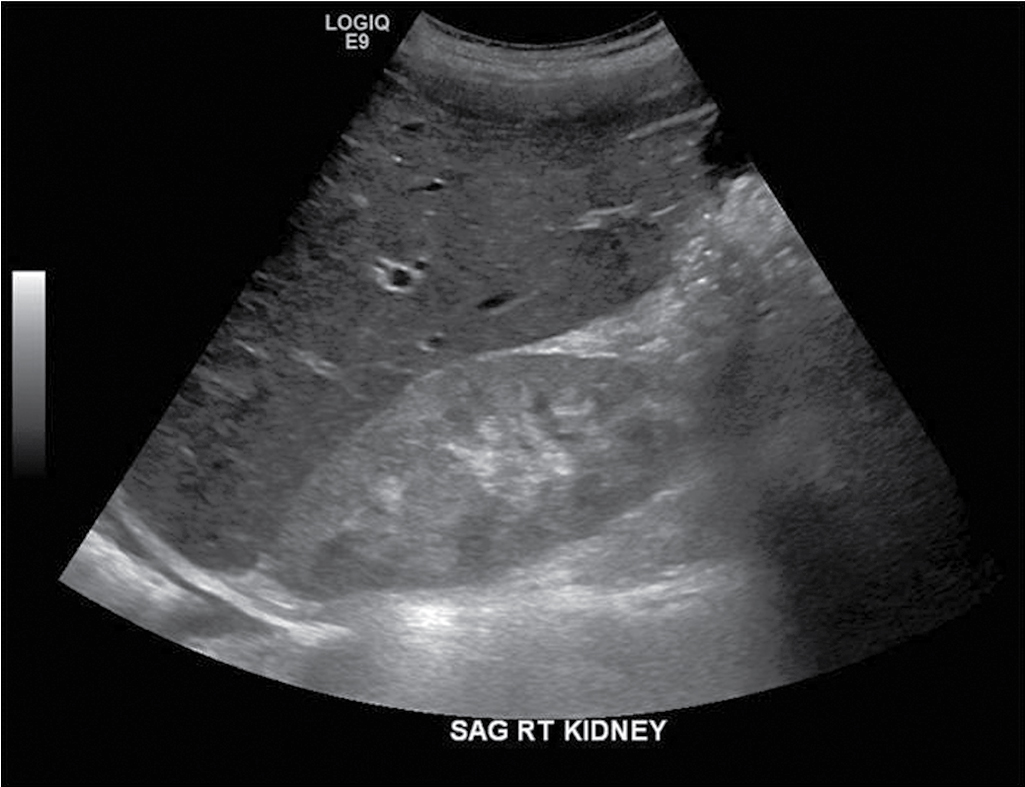 Fig. 25.2, Bilateral renal enlargement from glomerulonephritis. Images from a renal ultrasound reveal enlarged kidneys bilaterally (both kidneys >13 cm length, right kidney pictured) with increased parenchymal echogenicity compared with the adjacent index organs. The examination was performed to rule out obstruction, when elevated blood urea nitrogen and creatinine levels were discovered in a 26-year-old woman. Note the right pleural effusion. The liver and spleen were also enlarged. The patient was ultimately diagnosed with rapidly progressive glomerulonephritis associated with systemic lupus erythematosus.