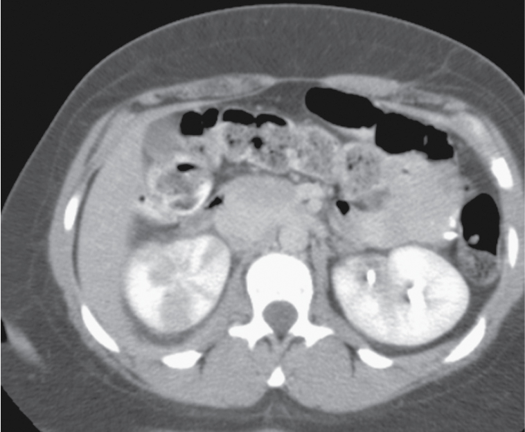 Fig. 25.5, Contrast-enhanced computed tomography study in a young woman with suspected appendicitis. An enlarged right kidney is seen with multiple wedge-shaped nonenhancing areas and perinephric stranding, findings consistent with acute pyelonephritis.