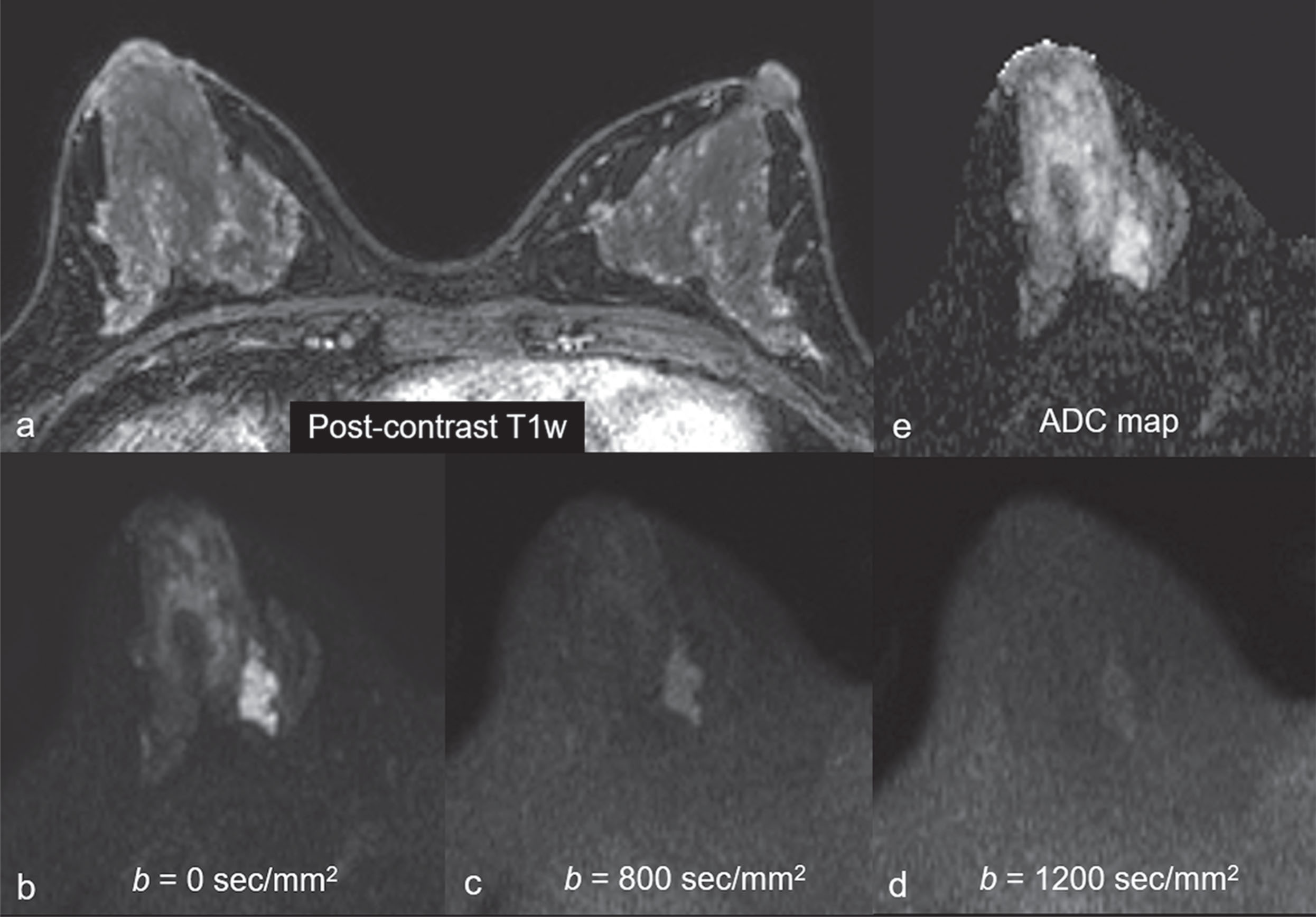 Fig. 6.4, A 45-year-old woman with mucinous carcinoma.