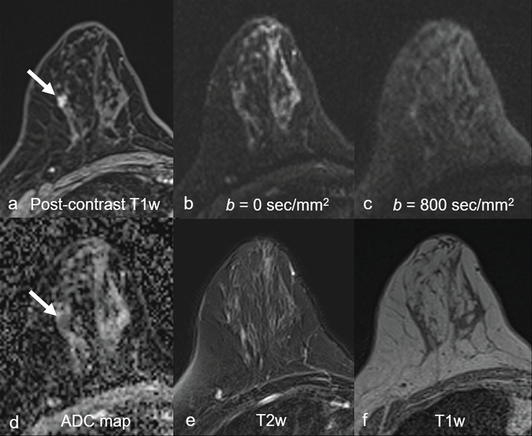 Fig. 6.5, A 61-year-old woman with a small invasive cancer.