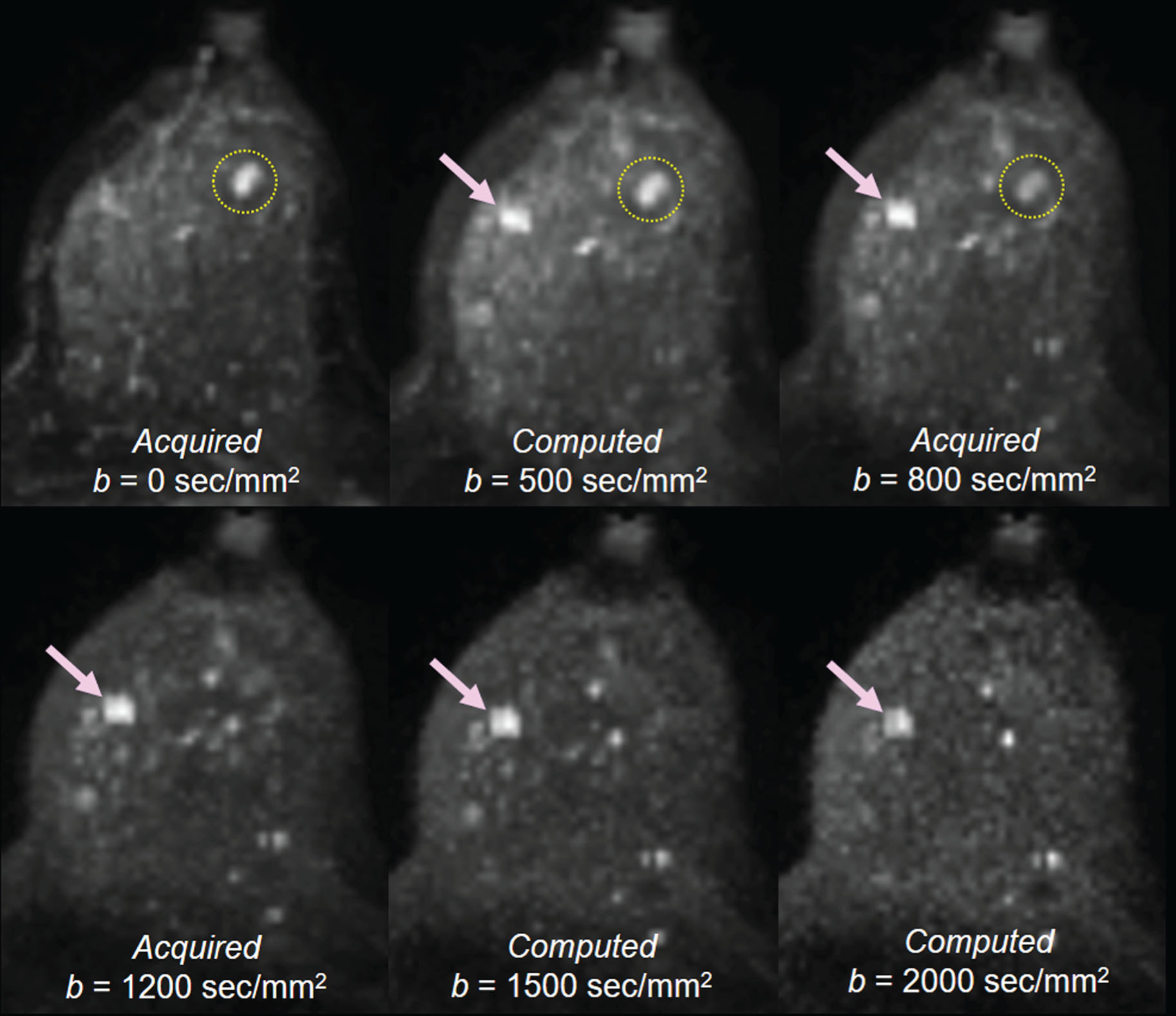 Fig. 6.7, A 47-year-old woman with an invasive cancer in the left inner breast and a benign mass in the left outer breast.