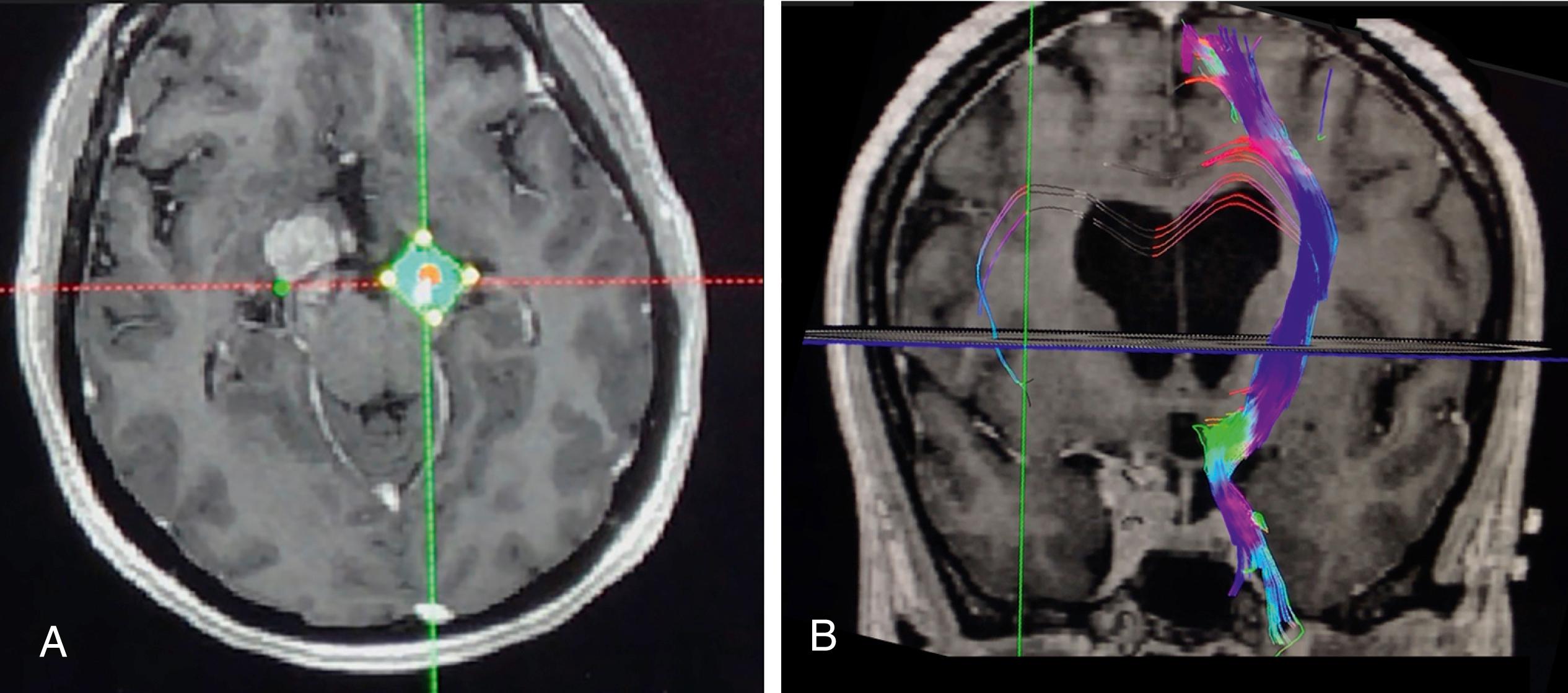 Figure 14.1, Using specialized diffusion tensor imaging (DTI) tractography software (Nordic Neurolabs BrainEx), a user can select a region of interest as shown in (A) incorporating the cerebral peduncle on the left, opposite to a tumor affecting the right side. (B) The deterministic tractography then generates a three-dimensional tractographic representation of the pyramidal tract running both cranially and caudally through the image volume.