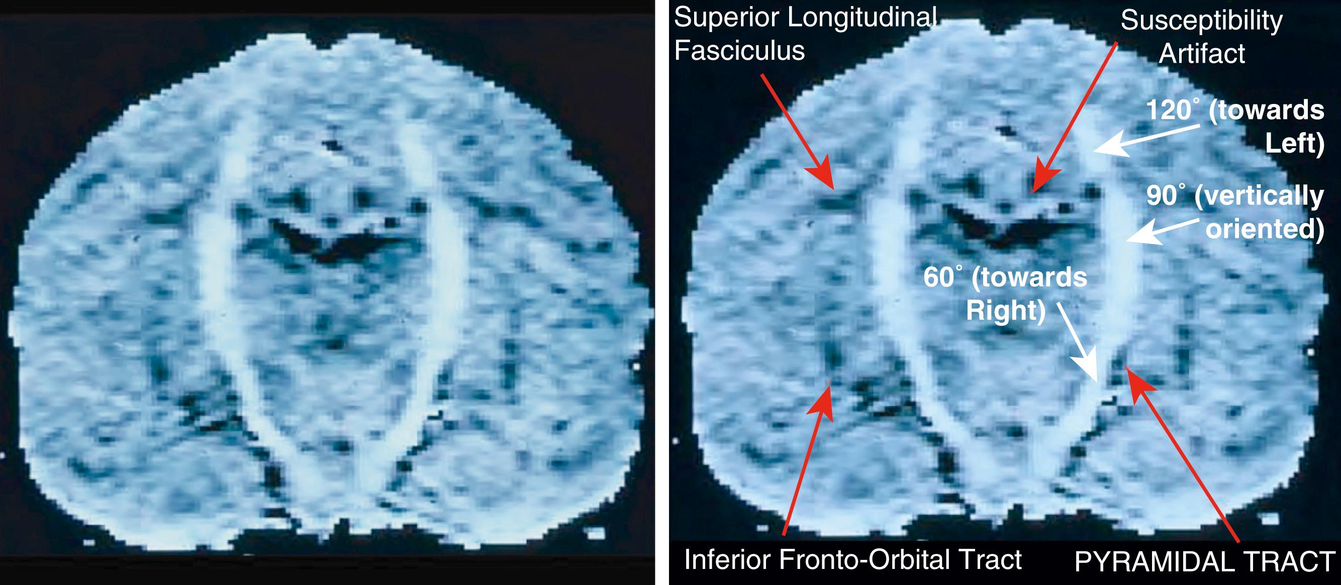 Figure 14.4, The image on the left is the first tractogram explaining in the patent that an infinite number of gradient directions could be applied and then calculated by tensor and vector analysis methods. This image was made by applying a seed-based connectivity algorithm from an MR angiography application but using the criteria of adjacency and similarity of arctangent orientation to select and extend voxel inclusion. The result was a curving tractogram on each side, selectively showing the pyramidal tract bilaterally.