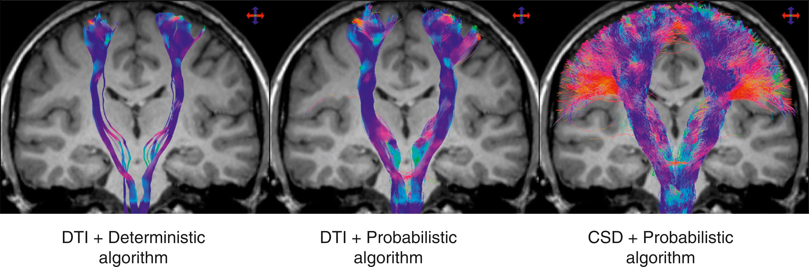 Figure 14.6, Fiber-tracking results in a healthy human subject obtained using a seed region in the brainstem and target region in the sensorimotor cortices.