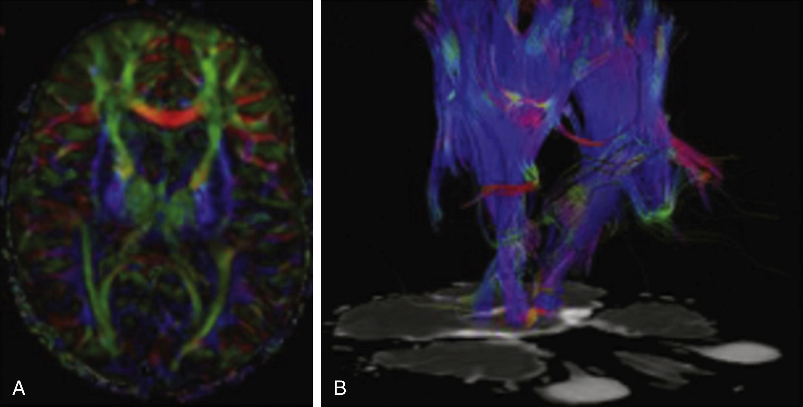 FIGURE 3.2, Output of fiber-tracking algorithms can be viewed on (A) two-dimensional (2D) magnetic resonance imaging (MRI) slice projections or (B) as a three-dimensional (3D) map, which can be integrated into intraoperative neuronavigation systems. In the 2D projection (A), there is a color convention whereby red represents fibers in the x-axis (left-right), green represents fibers in the y-axis (anterior-posterior) and blue represents fibers in the z-axis (cranial-caudal).