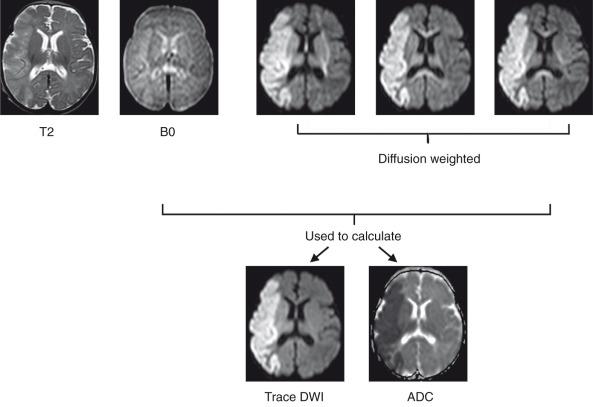 Figure 26.2, Diffusion-weighted imaging demonstrated in a 3-week-old neonate with an acute stroke.