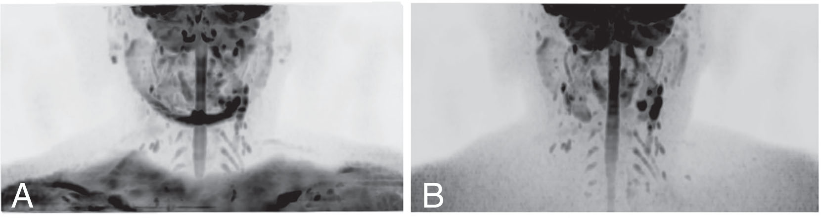 Fig. 11.3, Comparison of STIR-EPI and SE-EPI with CHESS pulse regarding the degree of fat suppression in a 28-year-old man with swollen lymph nodes (pathology unknown).