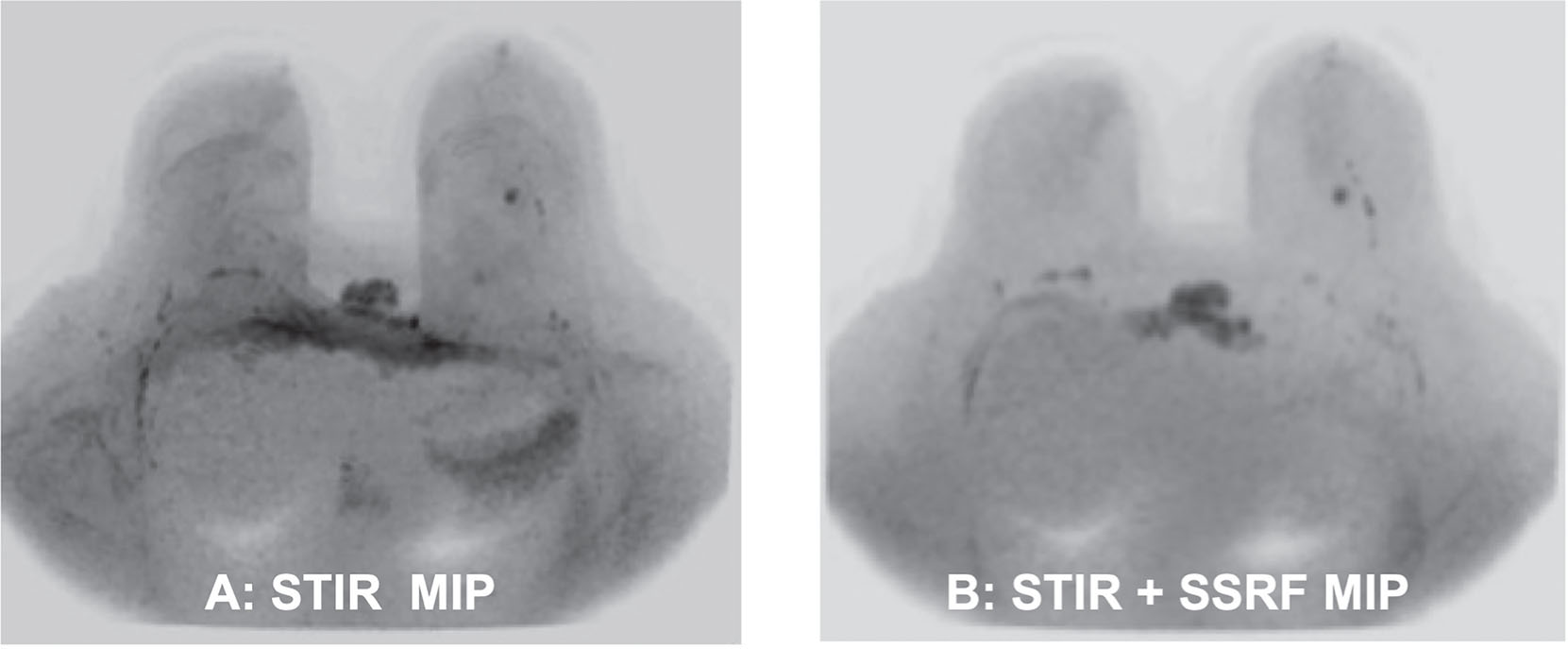 Fig. 11.5, STIR alone versus STIR + SSRF for fat suppression at 3 T.
