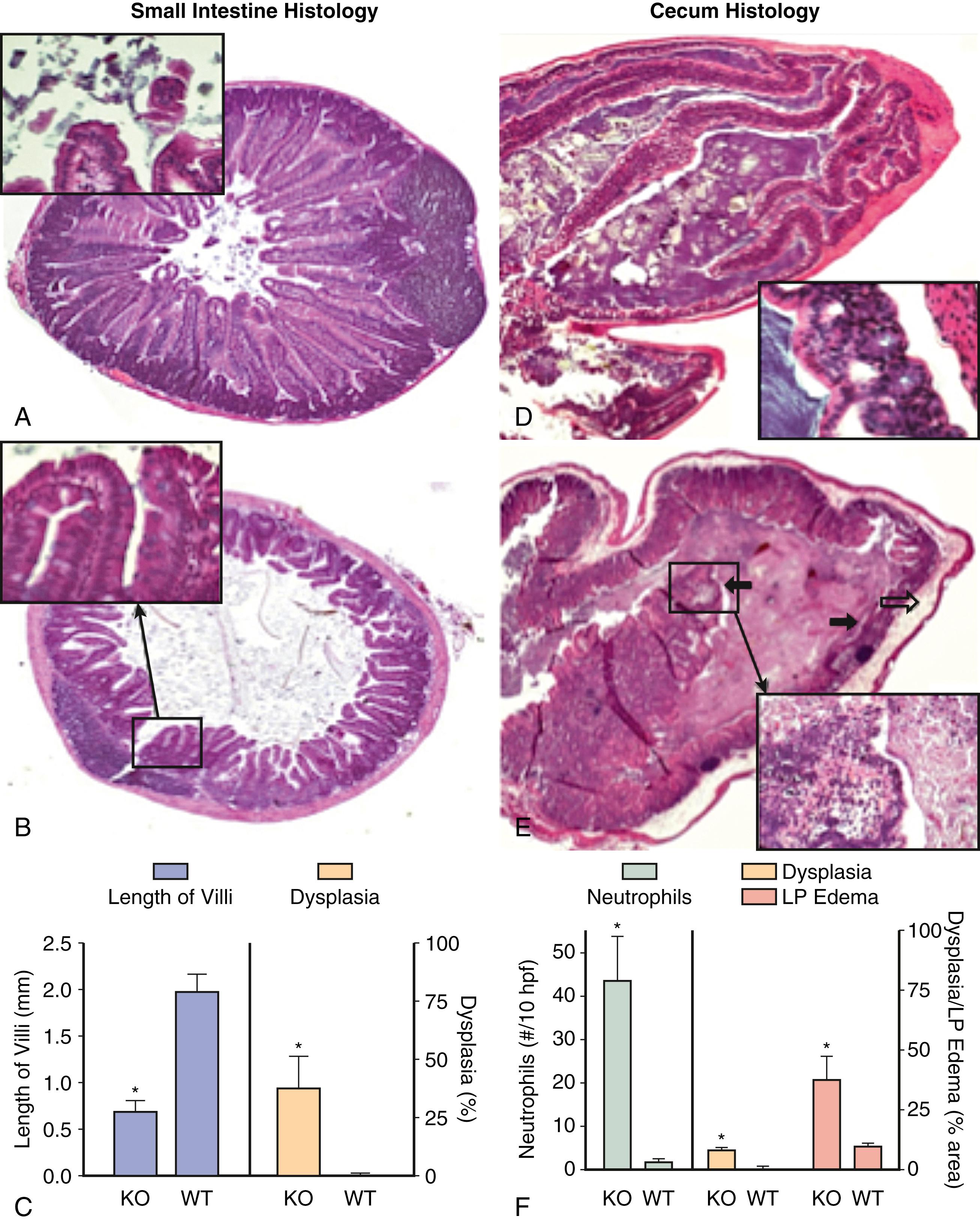 Fig. 103.3, Histology of the small intestine ( A-C ) and cecum ( D-F ) of intestinal-specific (conditional) Na + -dependent multivitamin transporter knockout ( KO ) mice and their sex-matched wild-type ( WT ) littermates. A, Normal small intestinal morphology of WT littermates. B, Shortening of villi and focal dysplastic changes ( B insert ). C, Small intestinal villi length in mm ( left y-axis ) and total area of dysplasia as a percentage ( right y-axis ). (∗ P < 0.01, n = 5). D, Representative section of WT cecum. E, Small intestine of the KO mouse showing significant submucosal edema ( open arrow ) and acute inflammation involving surface ( closed arrows ) and crypts. F, Number of neutrophils in 10 high-power fields (×400) ( left y-axis ), and total area of dysplasia and submucosal edema as a percentage ( right y-axis ). (∗P < 0.01, n = 5). LP , Lamina propria.