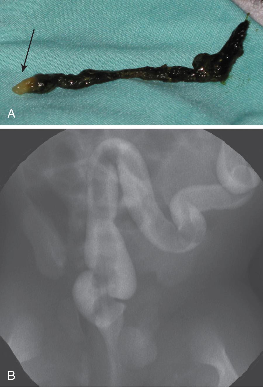 Fig. 123.1, Meconium plug.
