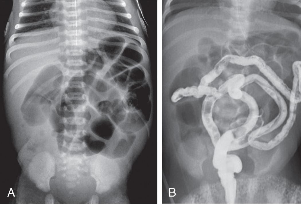 Fig. 123.3, Uncomplicated meconium ileus.