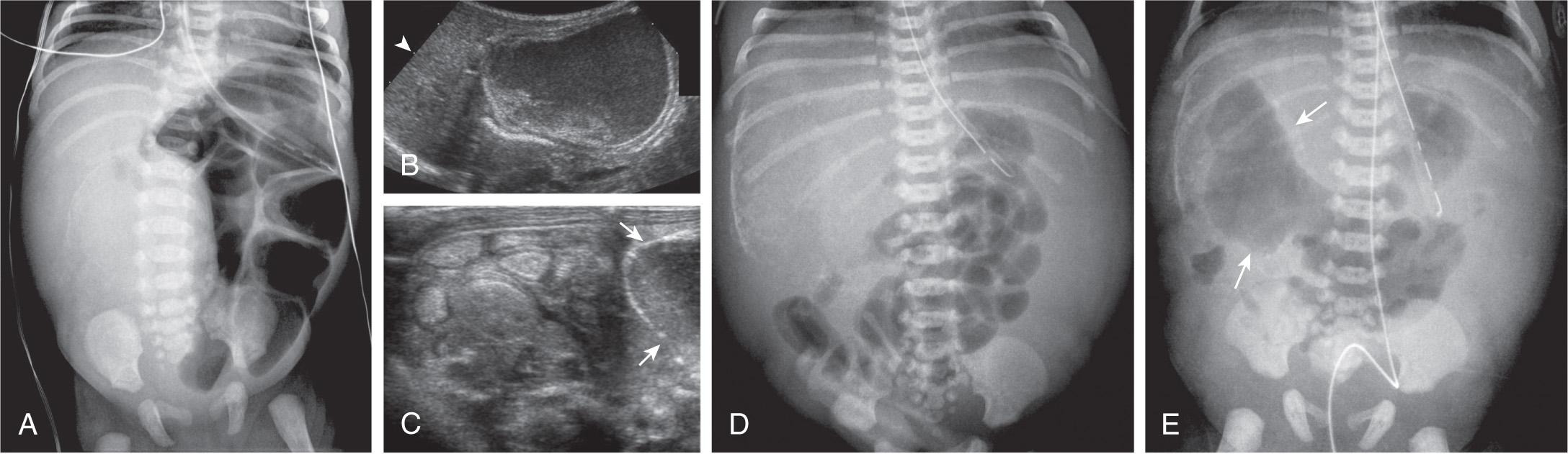 Fig. 123.4, Complicated meconium ileus.