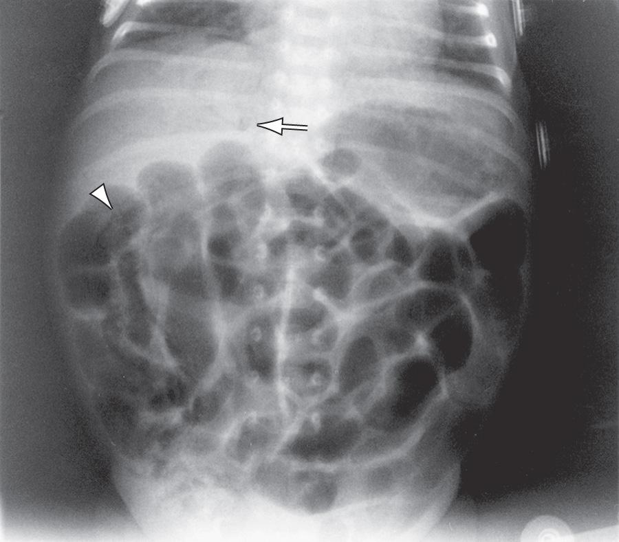Fig. 123.5, Necrotizing enterocolitis (NEC).