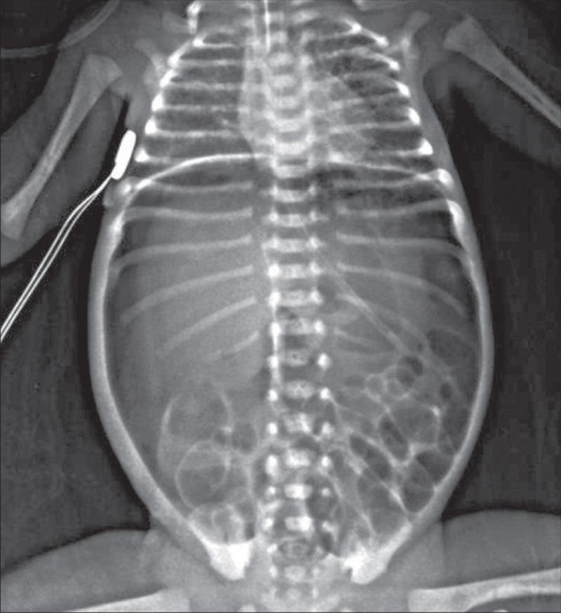 Fig. 123.7, Necrotizing enterocolitis (NEC).